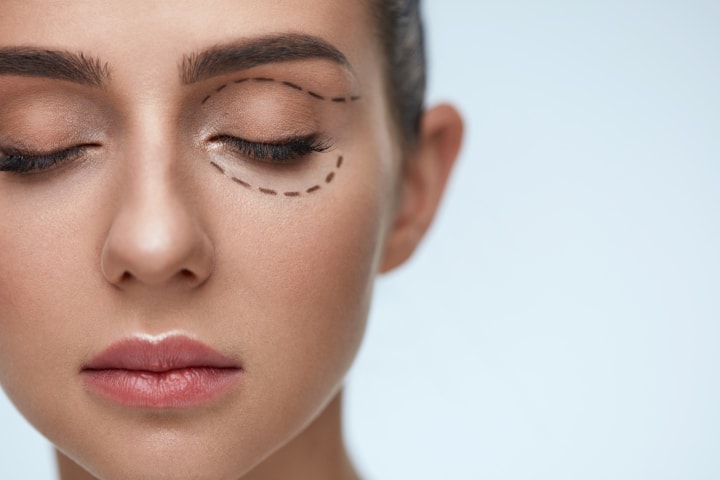 Is surgery necessary to get rid of dark circles?