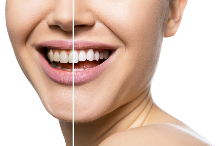 Steps To Safe Teeth Whitening