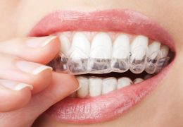 Which Teeth Whitening Products Work Best?